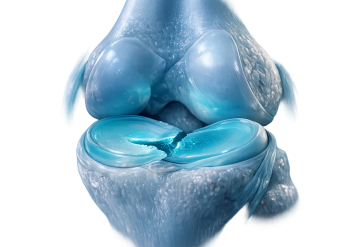 Ρήξη μηνίσκου: Συμπτώματα, πότε χρειάζεται χειρουργείο & επιλογές θεραπείας